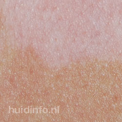 vitiligo witte plekken