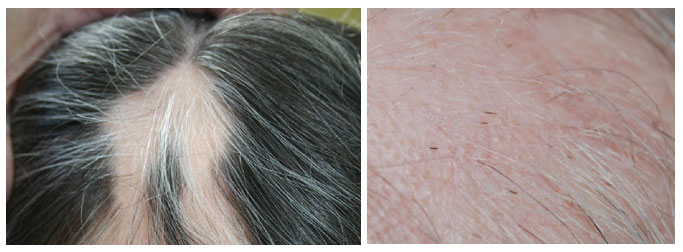 alopecia areata