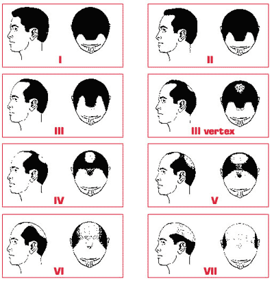 alopecia androgenetica man