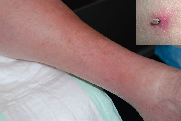 buchwald teek acrodermatitis