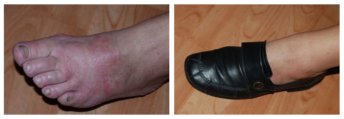 contact allergisch eczeem leer schoen voet