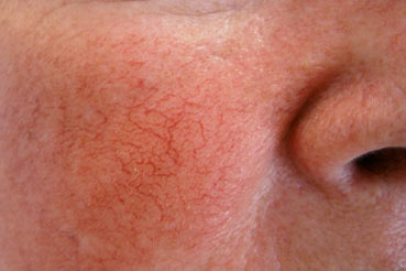 couperose rosacea