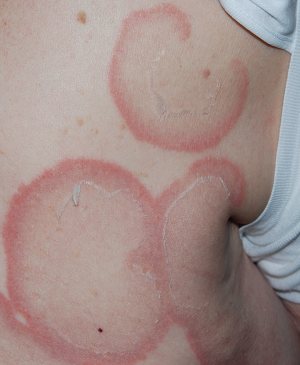 erythema annulare