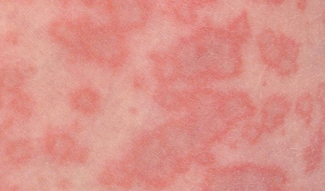 erythema infectiosum vijfde ziekte huiduitslag