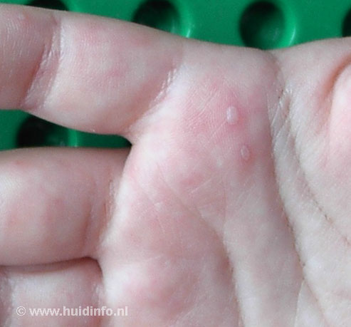 hand voet mondziekte