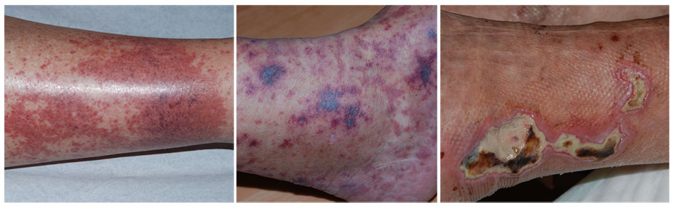 leucocytoclastische vasculitis