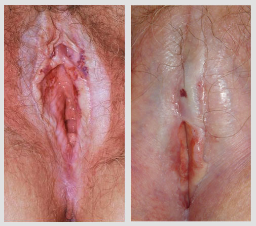 lichen sclerosus vulva
