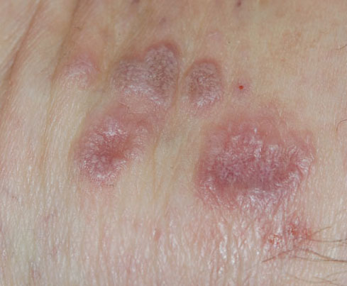 lichen planus