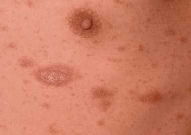 pityriasis rosea