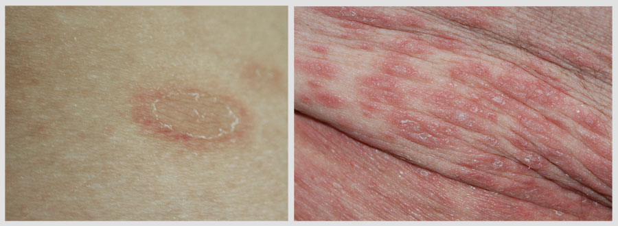 pityriasis rosea