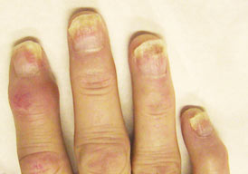 artritis psoriatica handen