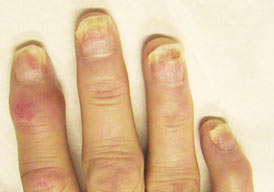 artritis psoriatica)