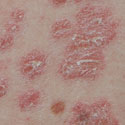 psoriasis