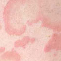 galbulten (urticaria)