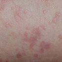 lichen planus