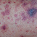 vasculitis