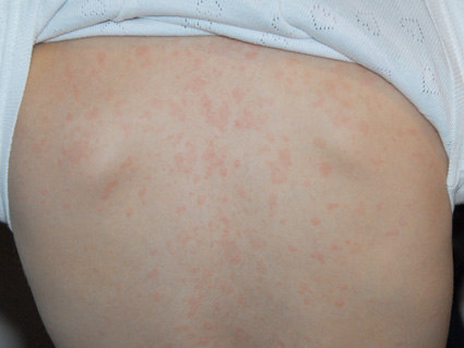 zesde ziekte exanthema subitum roseola infantum