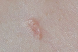sarcoidose huid
