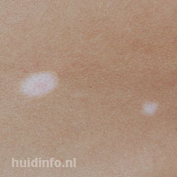 tubereuze sclerose huid witte vlekken
