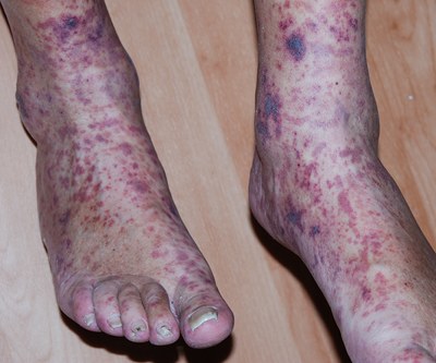 leucocytoclastische vasculitis petechieën