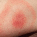 erythema migrans