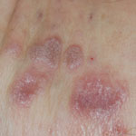 lichen planus