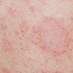 pityriasis rosea