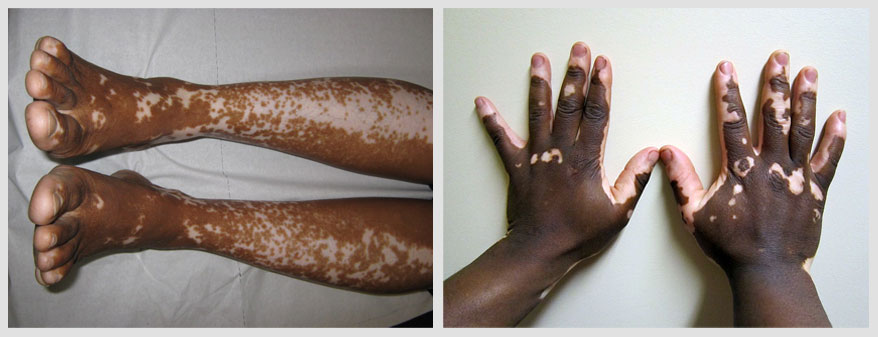 vitiligo