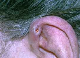 kussenduivel chondrodermatitis nodularis helices