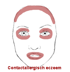 eczeem in het gezicht contact allergisch