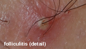 puistjes folliculitis