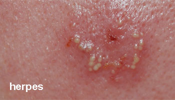 puistjes herpes