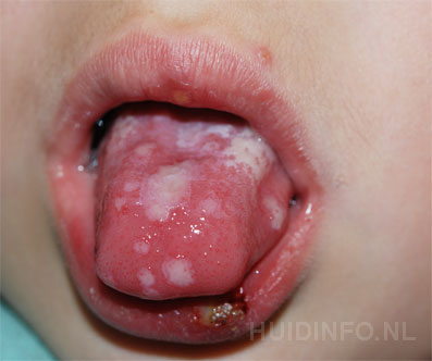 herpes simplex stomatitis