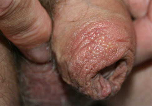 genitale herpes
