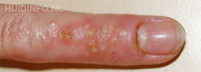 herpes simplex herpetic whitlow