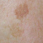 Bruine vlekken op de huid lentigo