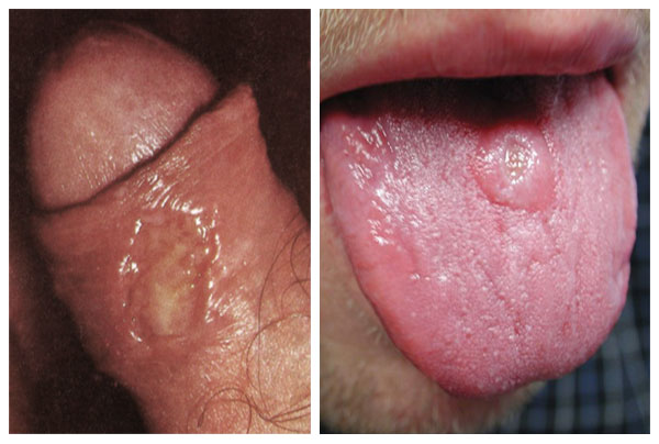 Ulcus durum | Syfilis (klinický obraz). 2020-02-28