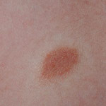 Bruine vlekken op de huid mastocytoom