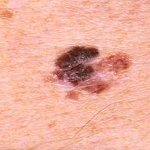 bruine vlekken op de huid melanoom