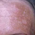Bruine vlekken op de huid melasma