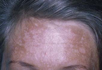 melasma zwangerschapsmasker