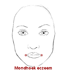 eczeem in het gezicht mondhoekeczeem