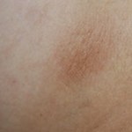 Bruine vlekken op de huid morfea