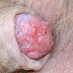 huidproblemen van de penis peniscarcinoom