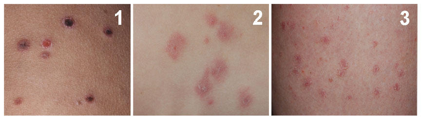 pityriasis lichenoides