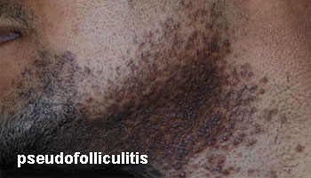 puistjes pseudofolliculitis