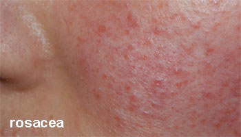 puistjes rosacea