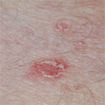 pityriasis lichenoides schilferende plekken