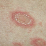 pityriasis rosea schilferende plekken