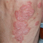 psoriasis schilferende plekken